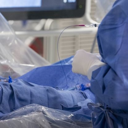 A close-up of the Y-90 treatment