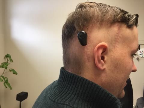 In the BAHA procedure, a titanium implant is surgically placed into the bone behind the ear. Once the implant has healed in place, a sound processor is attached and activated, providing transmission of sound and significant hearing improvement for the patient. Kingston's first BAHA recipient, Adam Pennock (pictured here), describes the technology as "very cool."