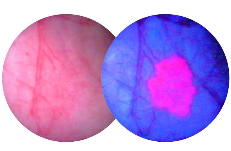 A bladder tumour as seen through a white light scope (L) and a blue light scope (R)